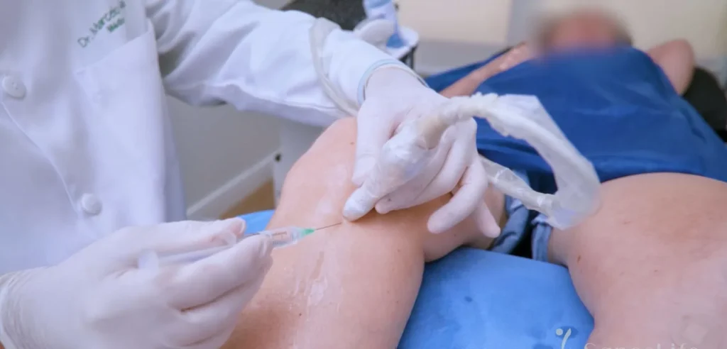 Viscossuplementação com Ácido Hialurônico