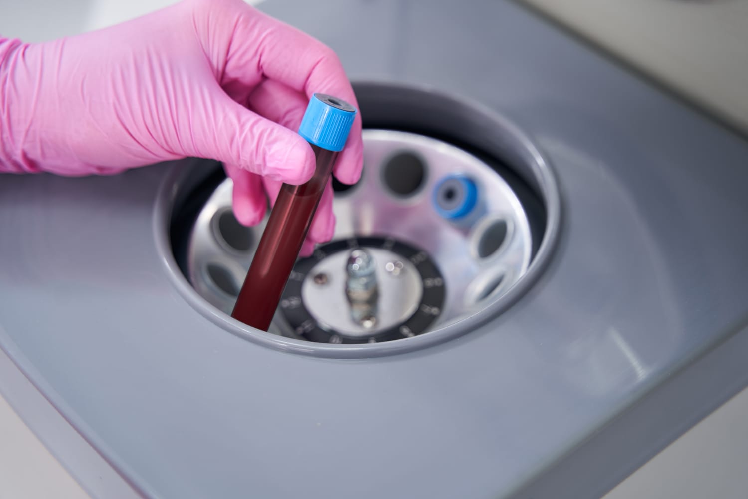 Plasma Rico em Plaquetas (PRP)