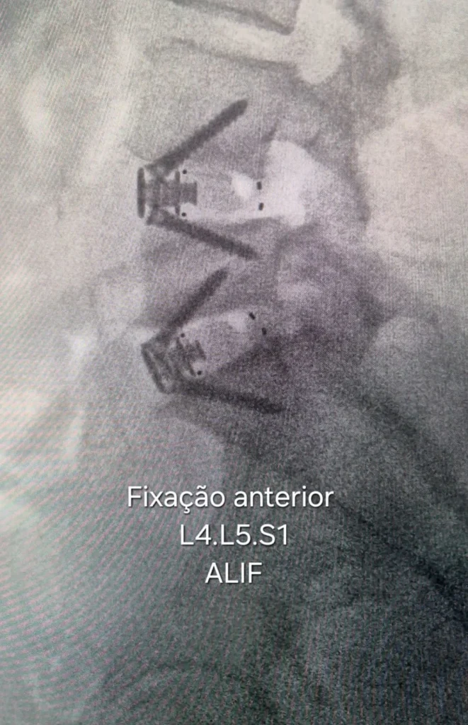Artroplastia da Coluna